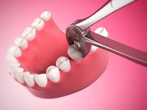 Extractions