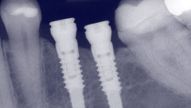 Dental Implants in Prince George - Accent Dental Features Services