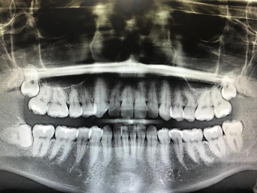 Wisdom Teeth