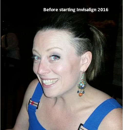 Invisalign - Heather's Story