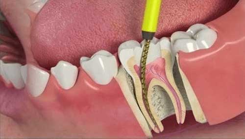 Root Canals