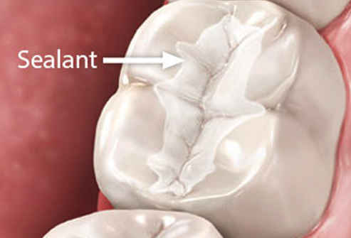 Sealants in Prince George | Accent Dental