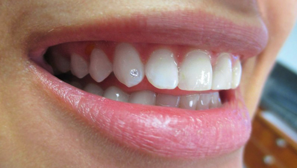Dental Diamonds in Prince George - Accent Dental Features Services